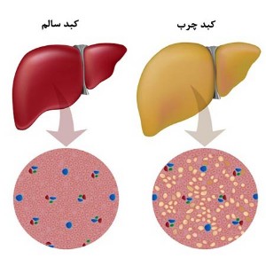 fatty liver (3)