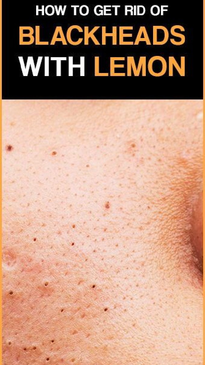 دلیل بروز دانه های سرسیاه روی پوست